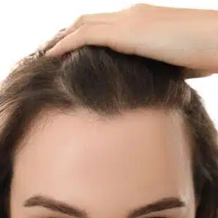 Alopecia feminina: como identificar os sinais e buscar tratamento